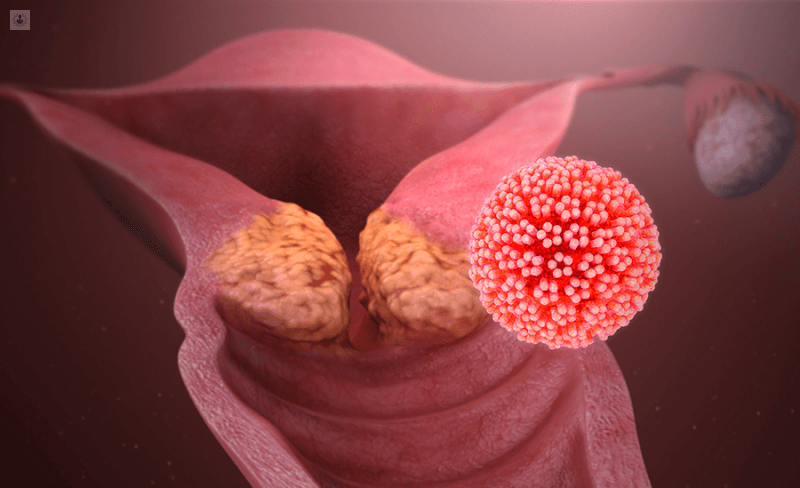 Hablemos de… Virus del Papiloma Humano